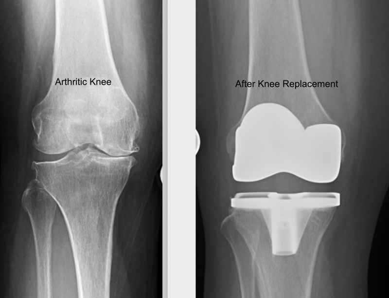 Go Home Same Day after Knee Replacement Dr. Barry Cayen Toronto